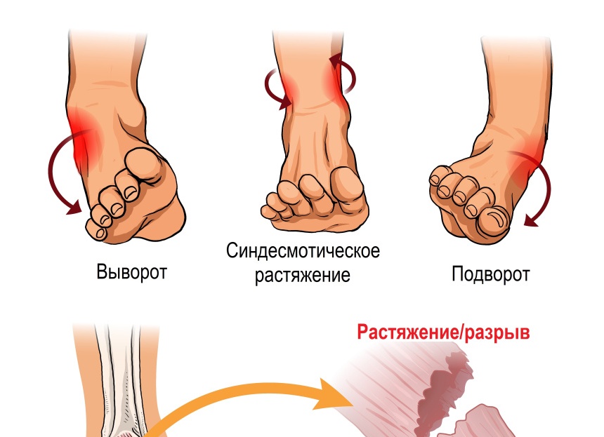 Как распознать растяжение связок и что с ним делать