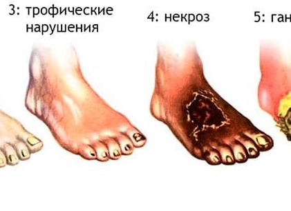 Почему развивается гангрена и как не допустить её появления